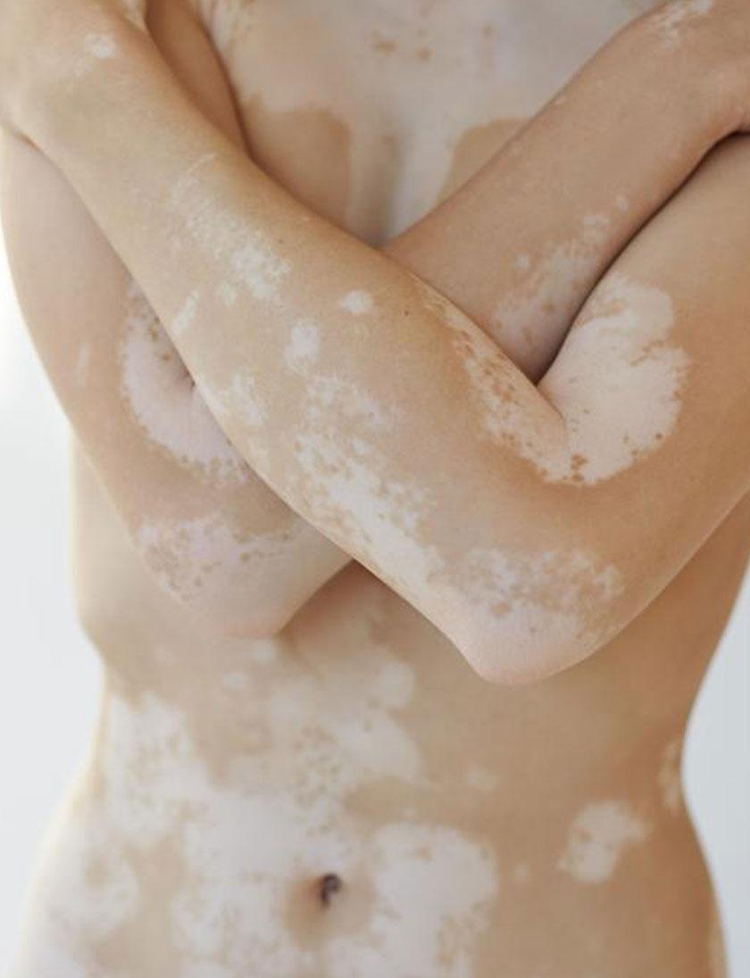 Vitiligo